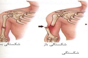 دانلود 4 پاورپوینت شکستگی کمیاب و عالی
