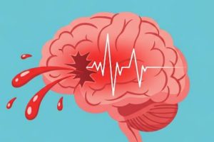 دانلود ppt خونریزی مغزی کمیاب و عالی