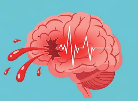 دانلود ppt خونریزی مغزی کمیاب و عالی